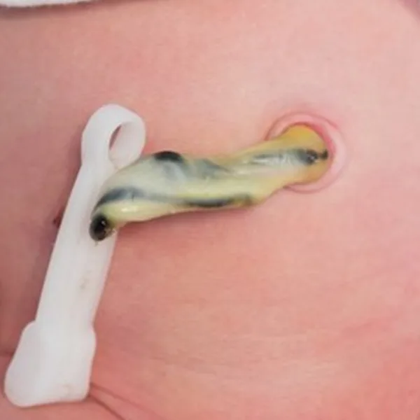 La sangre del cordón umbilical es muy rica en células madre y tiene una aplicación práctica: el trasplante