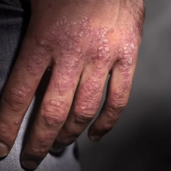 Vivir con psoriasis: "Rechacé planes en piletas para no exponer mis brazos y piernas"