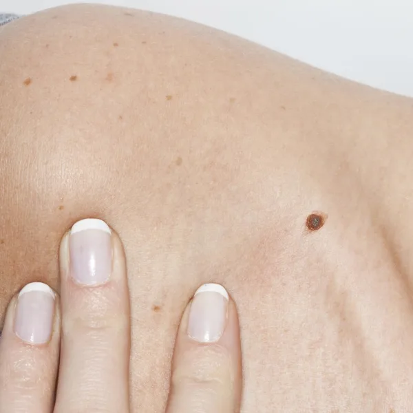 Chequeos de lunares de forma gratuita para detectar el cáncer de piel