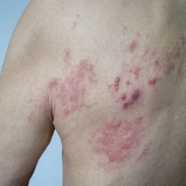 Herpes Zóster: ¿Qué tenemos que saber sobre la enfermedad?