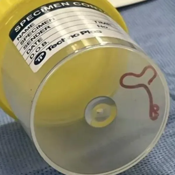Australia: extraen por primera vez un gusano parásito de casi 8 cm del cerebro de una mujer