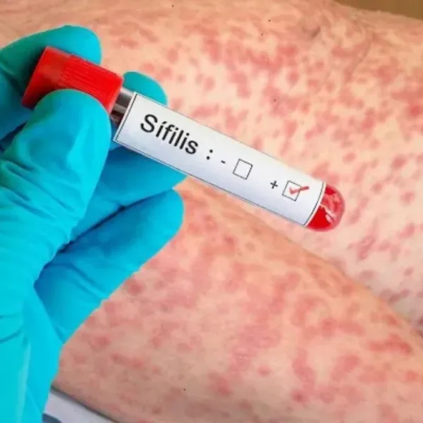 Alarma sanitaria en Córdoba y en todo el país por un récord de casos de sífilis
